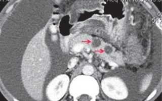 УЗИ  и КТ при остром панкреатите