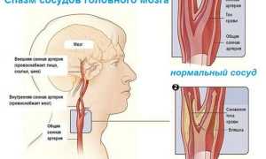 Судороги в голове причины