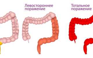 Геморрагический и гнойный проктит