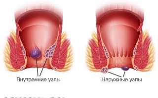 Как отличить рак прямой кишки от геморроя?