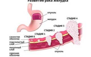 Онкологические заболевания (рак) желудка, стадии, прогноз